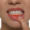 Periodontal Disease