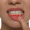 Periodontal Disease